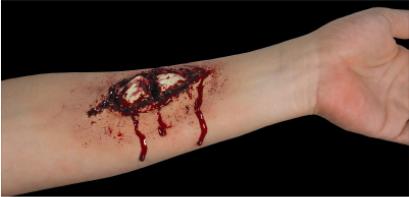 Woochie Broken Bone Compound Fracture